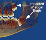 wisdom-teeth4.jpg
