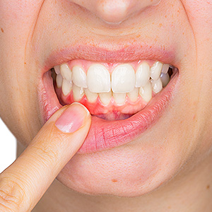 Stop Gum Disease Before it Becomes a Major Health Issue