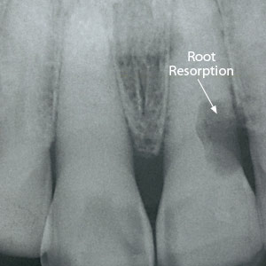 resorption root cervical xray dentistry decay problems phenomenon nechupadam