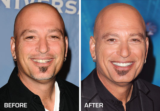 Howie Mandel Before and After Porcelain Veneers.