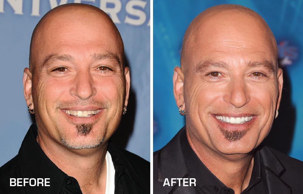 Howie Mandel Before and After Porcelain Veneers.