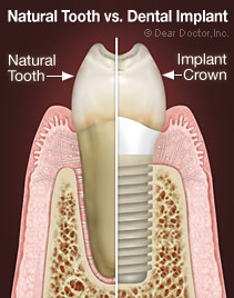 Dental Implants.