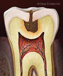 How do you Know if you have a Rotten Tooth?