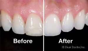 Porcelain Veneers.