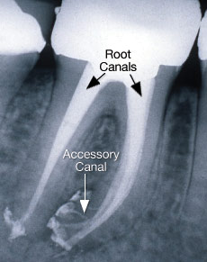 Accessory Root Canals X-ray