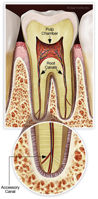 Accessory Root Canals - Learn about extra canals in root canal