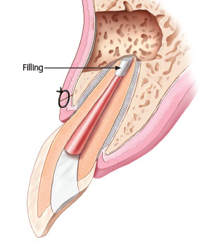 Apicoectomy - Small filling is placed.