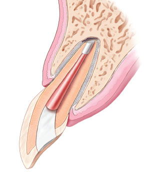 Apicoectomy - Healing.