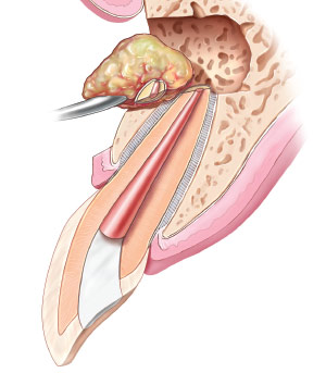Apicoectomy - Infection and root tip are removed.