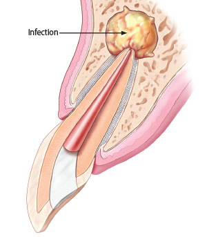 Apicoectomy - Previous root canal treatment can become reinfected.