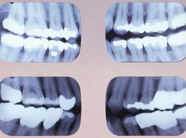 Series of 4 bitewing radiographs.