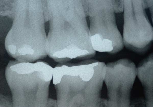 Image of a bitewing x-ray.