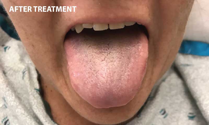 Black Hairy Tongue - After Treatment.