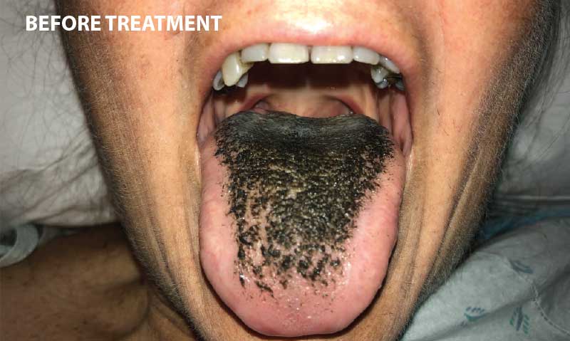 Black Hairy Tongue - Before Treatment.