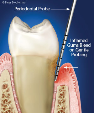 Bleeding gums illustration.