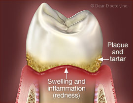 Bleeding gums