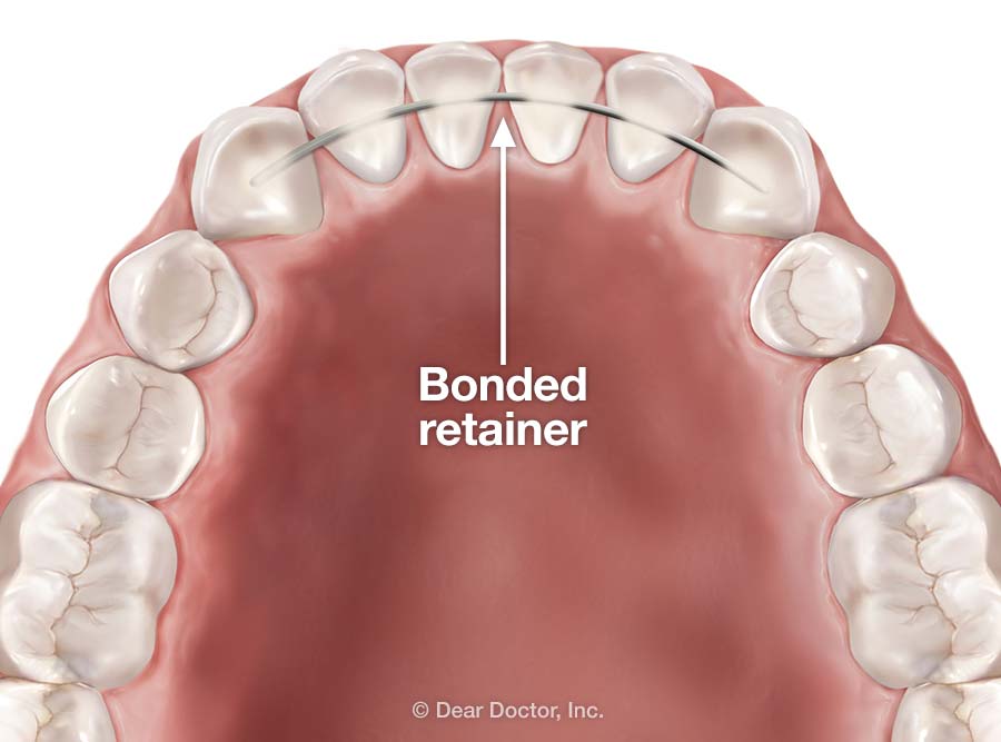 Bonded retainer.