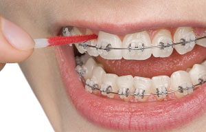 Wearing while braces gums swollen How to