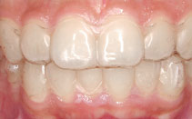 Invisalign aligners