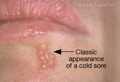 Cold Sore Closeup