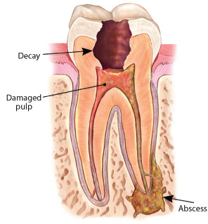 Root canal abscess