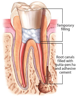 Root canal filling