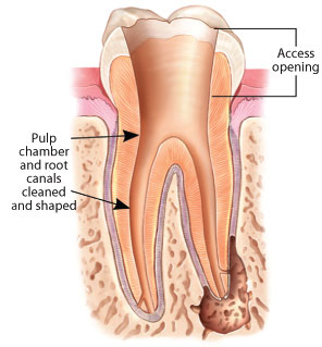 Root canal pulp chamber