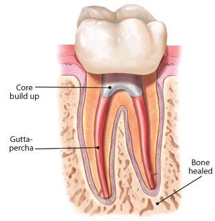 Root canal treatment