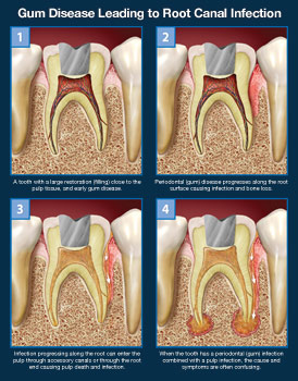Gum Disease leading to Root canal infection.