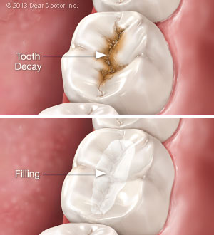 Tooth decay vs fillings.