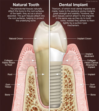 Dental implants vs natural teeth.