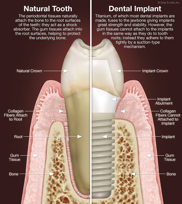 Dental Implants Mount Pleasant Sc