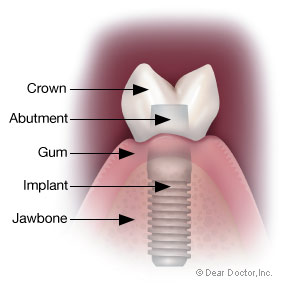 Dental implant