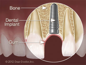 Dental implant placed.