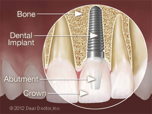 Dental implant surgery.