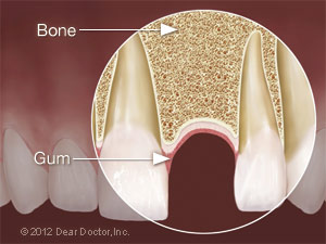 Ideal dental implant site.