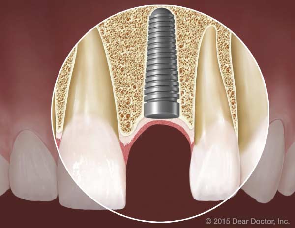 Dental implants and diabetes.