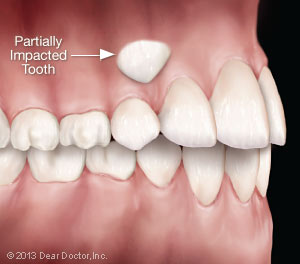 Partially impacted tooth.