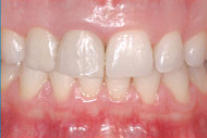 Thick tissue type