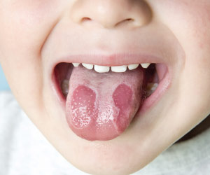 Geographic tongue.