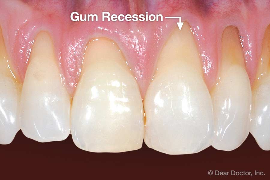 Gum recession.