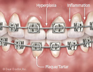 Gum swelling during orthodontics.