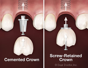 Cemented crowns versus screw-retained crowns