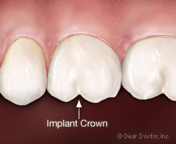 Dental implant crown.