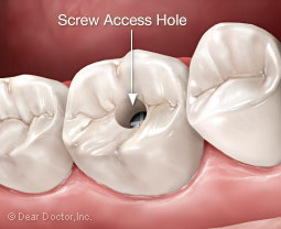 Dental implant screw access hole.