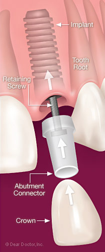 Dental implant assembly.