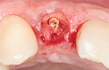 Fractured tooth