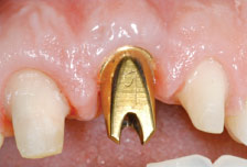 Dental implant abutment