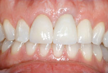 Dental implant crown