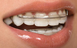 Orthodontic retainer on teeth.